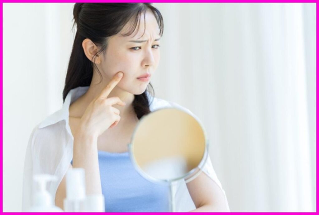 아직도 사춘기처럼 여드름 짜세요? 성인 여드름 악화시키는 최악의 습관