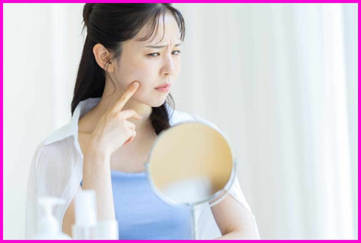 아직도 사춘기처럼 여드름 짜세요? 성인 여드름 악화시키는 최악의 습관